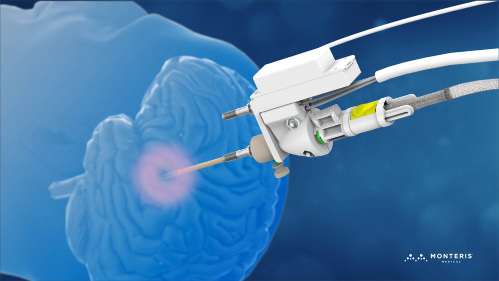 Impressive Milestone for Monteris Medical’s NeuroBlate® System