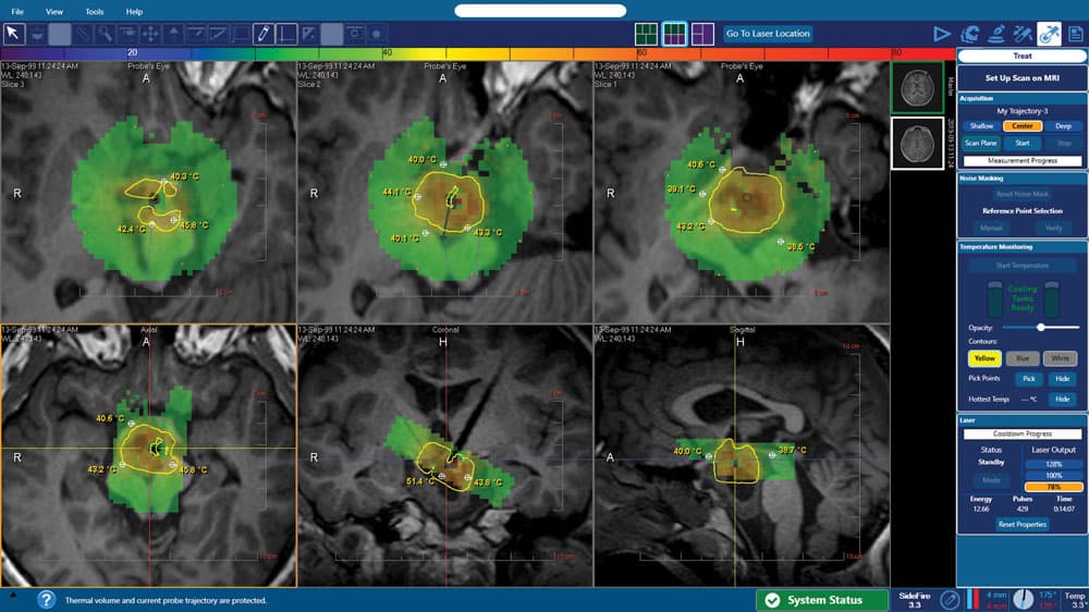 Monteris NeuroBlate Fusion-S™ Software Gets FDA Clearance