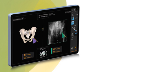 Smith+Nephew Launches RI.HIP NAVIGATION for Total Hip Arthroplasty