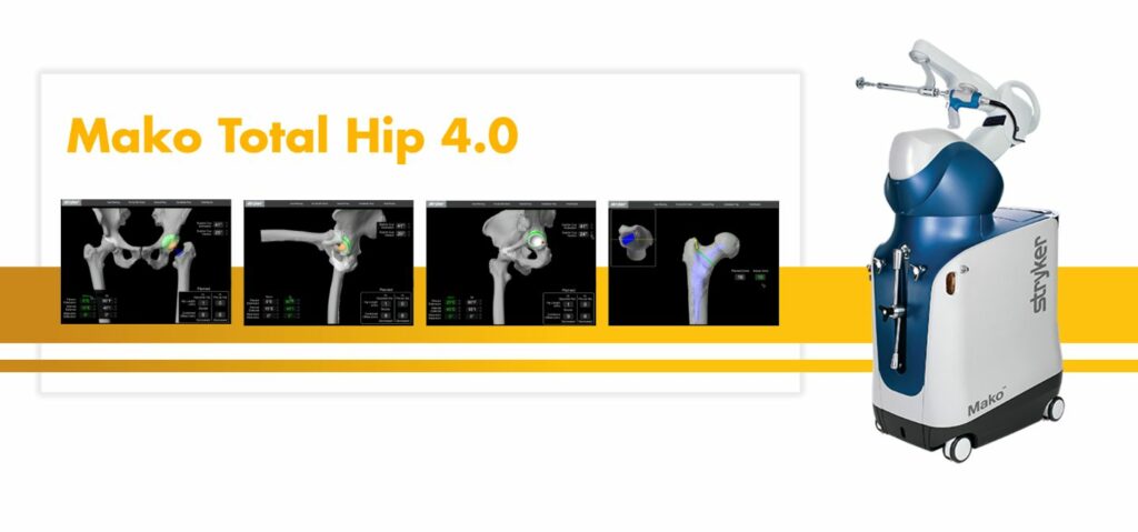 Stryker Announces New Mako Total Hip 4.0