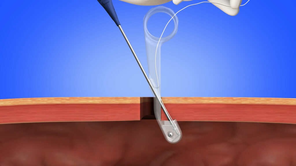 Sharp Fluidics® launches NeoClose® AnchorGuard for Laparoscopic and Robotic surgery