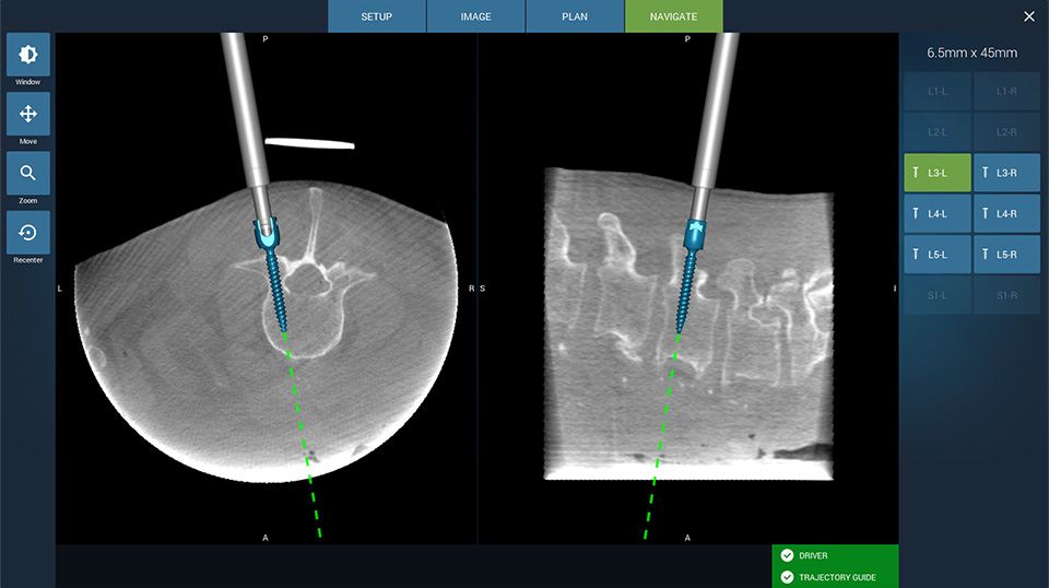 Fusion Robotics™ Secures 510(k) Clearance for Spinal Navigation & Robotics System