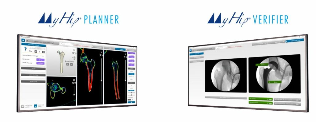 Medacta Expands Personalized Medicine Solutions for Hip Replacements