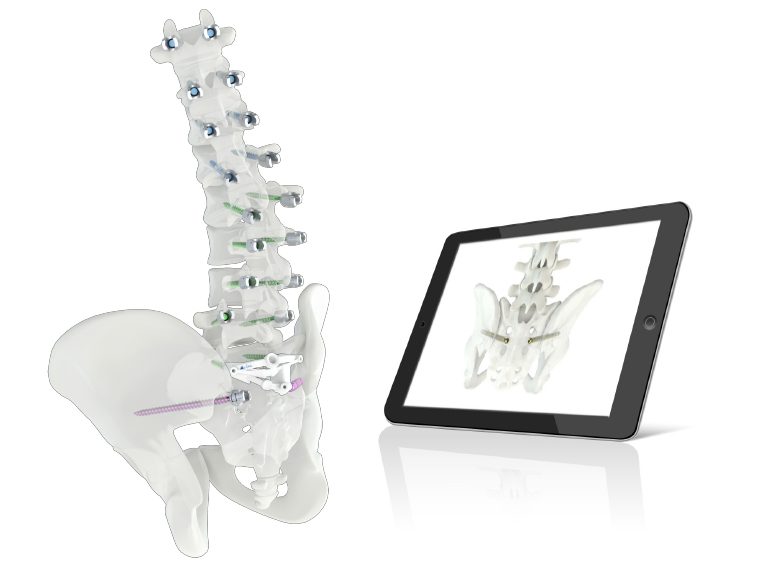 Medacta Launches MySpine for S2-Alar-Iliac Fixation