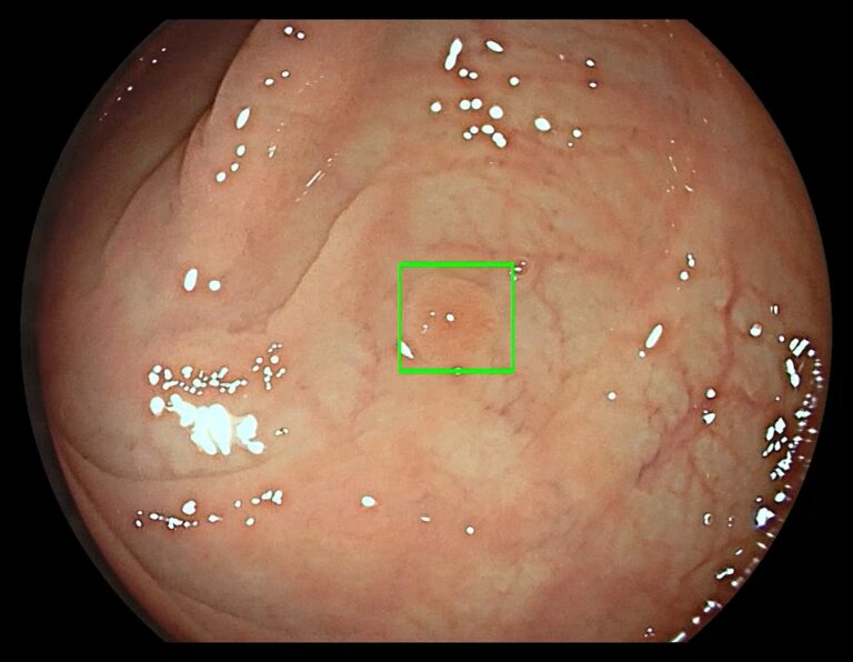 Medtronic-GI-Genius-Intelligent-Endoscopy-Module