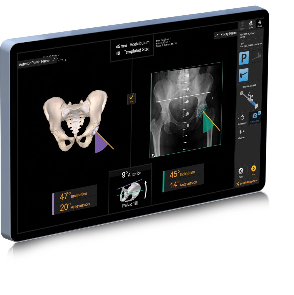 Computer-guided surgery with Smith+Nephew’s hip replacement implants provides significant patient benefits