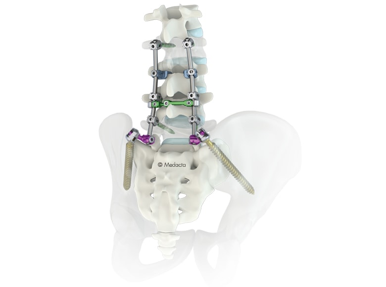 Medacta Announces First U.S. Surgery with M.U.S.T. LT System