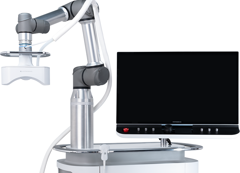 HistoSonics announces treatment of first patient in #HOPE4LIVER Europe trial