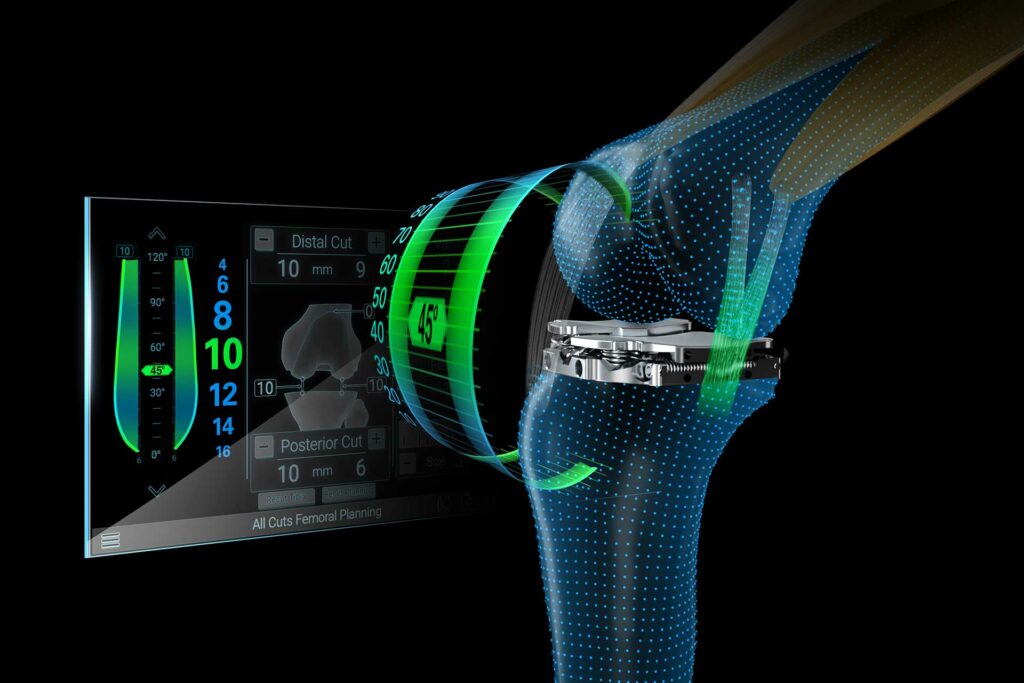Exactech Announces First Surgeries Using Newton™, an Active Intelligence® Technology