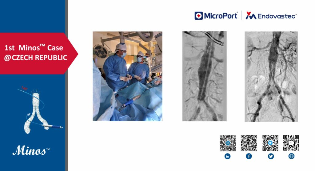 First Endovastec™ Minos® Stent Graft System Implantation in Czech Republic