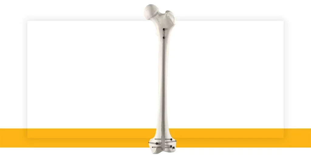 Stryker Announces Launch of T2 Alpha Femur Retrograde Nailing System