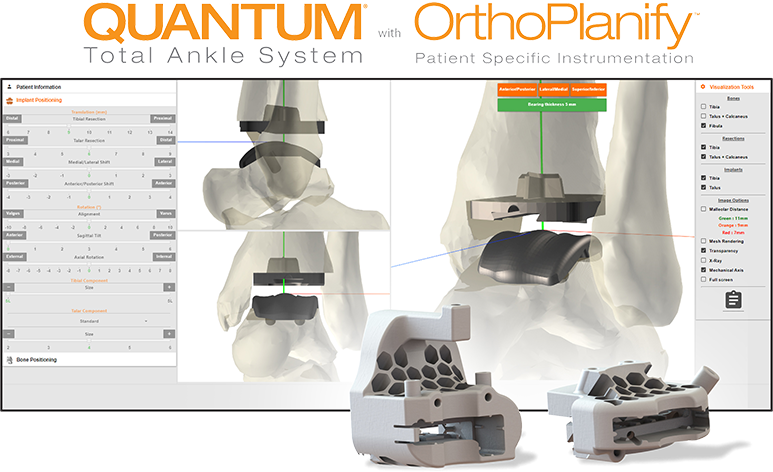In2Bones Wins FDA Clearance for OrthoPlanify™ Patient-Specific Planning Software