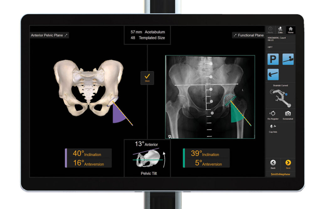 Smith+Nephew Expands CORI◊ Surgical System into Total Hip Arthroplasty with RI.HIP NAVIGATION