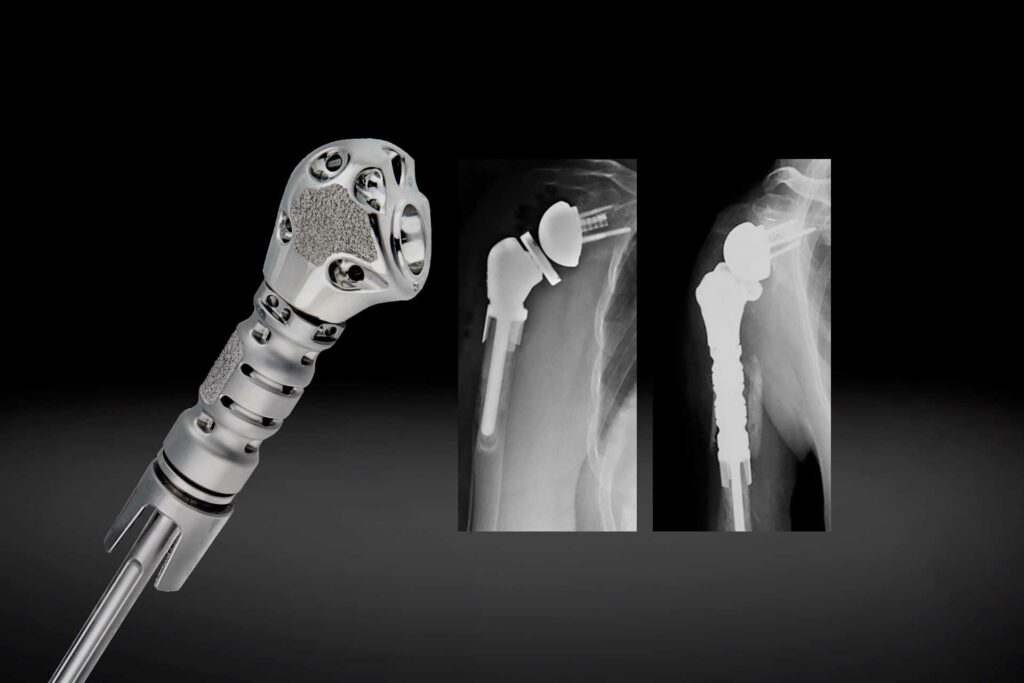 Exactech Launches Humeral Reconstruction Prosthesis in Europe