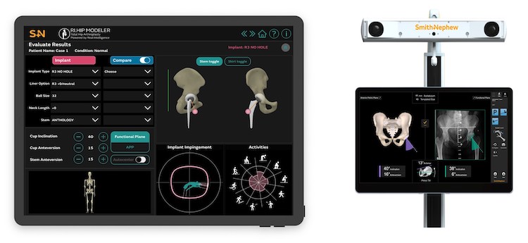 Smith+Nephew announces first total hip replacement cases on its CORI◊ Surgical System using RI.HIP MODELER and RI.HIP NAVIGATION
