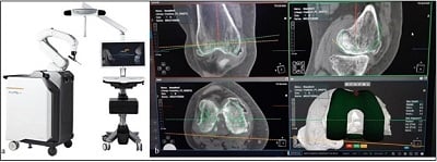 autonomous robotic system for total knee replacement