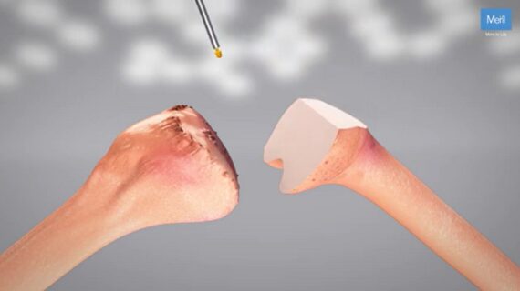 Human Meril Meril Life Sciences | Revolutionizing high-end robotic and orthopaedic ...