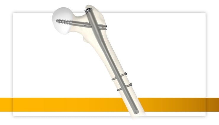 Stryker Gamma4 Portfolio