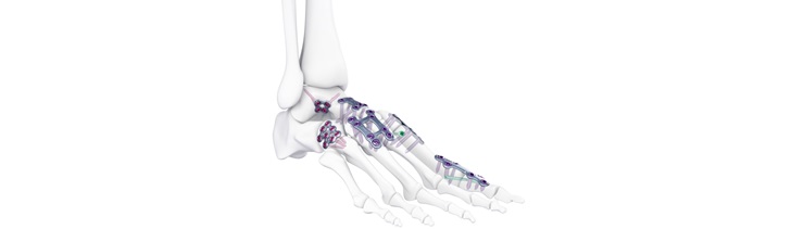 DePuy Synthes Launches TriLEAP™ Lower Extremity Anatomic Plating System