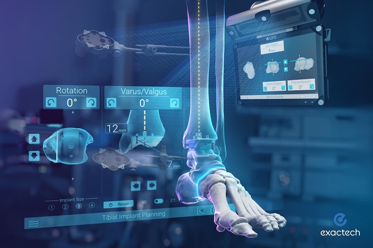Exactech Announces First Surgeries with ExactechGPS® Ankle Technology