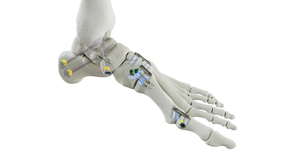 Medline Receives FDA Clearance for REFLEX® HYBRID Nitinol Implants
