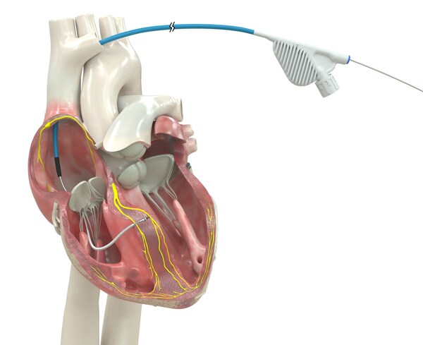 Medtronic OmniaSecure™  Receives FDA Approval for Conduction System Pacing