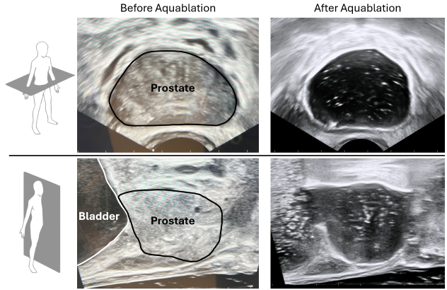Aquablation Therapy for Prostate Cancer