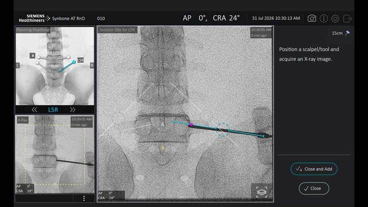 Trackerless Guidance in Spinal Surgery
